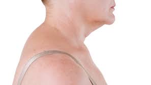 गर्दन का कूबड़ (Dowager's Hump) गर्दन के पीछे जमा होने वाले कूबड़ (फैट और टाइट मसल्स) को कैसे रोकें?