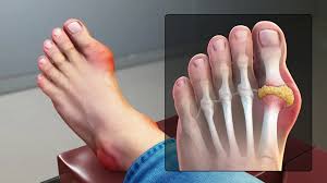 गाउट (Gout) का अटैक यूरिक एसिड बढ़ने पर अंगूठे के भयंकर दर्द में क्या सिकाई करें? (बर्फ या गर्म पानी)।