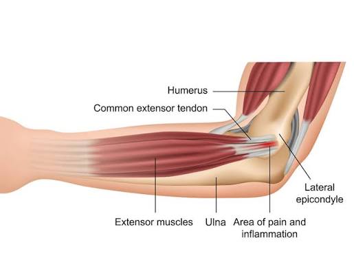 गोल्फर्स एल्बो (Golfer's Elbow) पुल-अप्स (Pull-ups) करते समय कोहनी के अंदरूनी हिस्से में दर्द क्यों होता है?