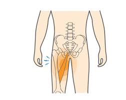 ग्रोइन पुल (Groin Strain) दौड़ते समय जांघ के अंदरूनी हिस्से में अचानक आई लचक का फिजियोथेरेपी प्रबंधन।