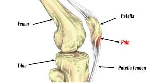 जंपर्स नी (Jumper's Knee) बास्केटबॉल और वॉलीबॉल खिलाड़ियों में पटेला टेंडन के दर्द को कैसे ठीक करें।