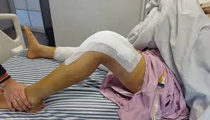 टीकेआर (TKR) रिहैब घुटने के रिप्लेसमेंट के बाद पहले 30 दिनों का स्टेप-बाय-स्टेप रिकवरी प्लान।