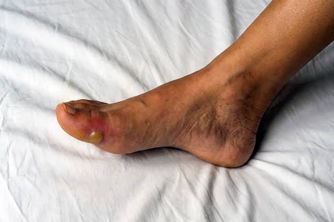 डायबिटिक फुट (Diabetic Foot) शुगर के मरीजों के लिए पैरों की विशेष देखभाल और सही जूतों का चुनाव।