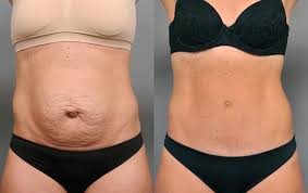 डायस्टेसिस रेक्टी (Diastasis Recti) प्रसव (Delivery) के बाद पेट की मांसपेशियों के बीच आए गैप को व्यायाम से कैसे भरें।