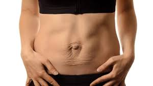डायस्टेसिस रेक्टी (Diastasis Recti) डिलीवरी के बाद अलग हुई पेट की मांसपेशियों को वापस जोड़ने के तरीके।