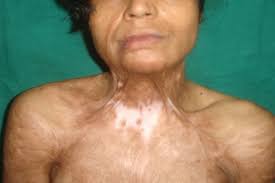 बर्न इंजरी (जलना) जलने के बाद त्वचा और जोड़ों को सिकुड़ने (Contractures) से रोकने के लिए स्ट्रेचिंग क्यों जरूरी है।