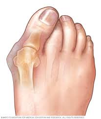 बूनियन्स (Bunions) पैर के अंगूठे की हड्डी बाहर निकलने (टेढ़ी होने) का कारण और टेपिंग से बचाव।