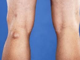 बेकर्स सिस्ट (Baker's Cyst) घुटने के ठीक पीछे पानी की गांठ बनना—यह घुटने के आर्थराइटिस से कैसे जुड़ी है?