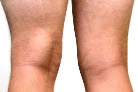 बेकर्स सिस्ट (Baker's Cyst) घुटने के ठीक पीछे बनी पानी की गांठ का फिजियोथेरेपी प्रबंधन।