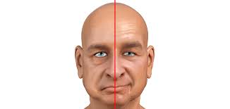 बेल्स पाल्सी (Bell's Palsy) चेहरे के लकवे के लिए फेशियल मसाज और मिरर व्यायाम।