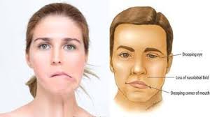 मिरर विजुअल फीडबैक चेहरे के लकवे (Bell's Palsy) में शीशे के सामने देखकर व्यायाम करने का विज्ञान