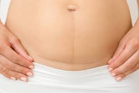 सी-सेक्शन स्कार मसाज सिजेरियन डिलीवरी के बाद पेट के टांकों के निशान के आसपास की त्वचा की मसाज क्यों जरूरी है।