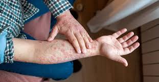 सोरायटिक अर्थराइटिस त्वचा की बीमारी (Psoriasis) के साथ जोड़ों में होने वाला सूजन और दर्द।