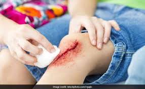 हीमोफिलिया (Hemophilia) इस जेनेटिक बीमारी में बार-बार जोड़ों के अंदर खून रिसने के बाद की सावधानी और फिजियो केयर।