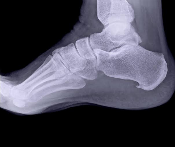 हील स्पर्स (Heel Spurs) एड़ी की हड्डी का कांटा बढ़ना—क्या इसके लिए हमेशा सर्जरी जरूरी है