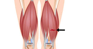 हैमस्ट्रिंग स्ट्रेन (Hamstring Pull) क्रिकेटर्स और फुटबॉलर्स में जांघ के पीछे खिंचाव आने के बाद वापसी का सही समय।