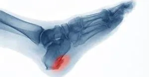 एड़ी की हड्डी बढ़ना (Heel Spur) और प्लांटर फेशिआइटिस के दर्द में क्या अंतर है?
