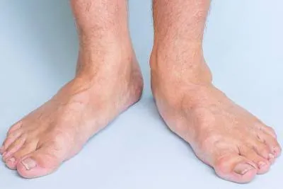 फ्लैट फुट (Flat Feet) की समस्या और शरीर के स्ट्रक्चरल अलाइनमेंट पर इसका गंभीर प्रभाव