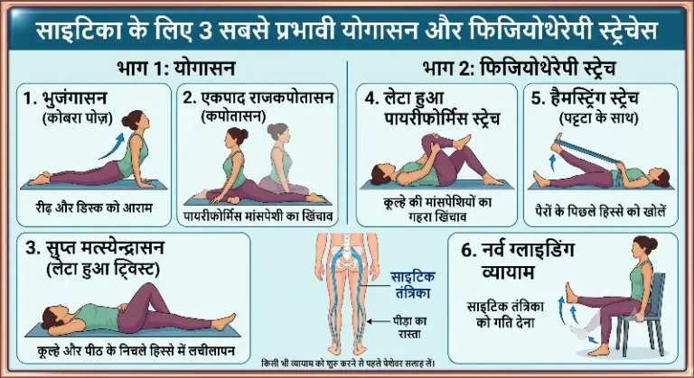 साइटिका के लिए 3 बेस्ट योगासन और फिजियोथेरेपी स्ट्रेचेस