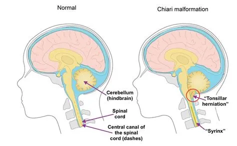 अर्नोल्ड-चियारी मालफॉर्मेशन (Arnold-Chiari Malformation)