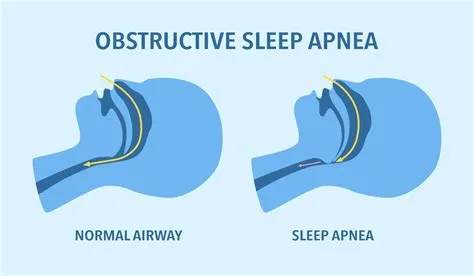 ऑब्सट्रक्टिव स्लीप एप्निया (Obstructive Sleep Apnea - OSA)