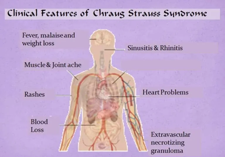 चर्ग-स्ट्रॉस सिंड्रोम (Churg-Strauss Syndrome)