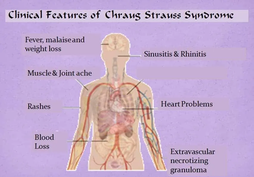 चर्ग-स्ट्रॉस सिंड्रोम (Churg-Strauss Syndrome)
