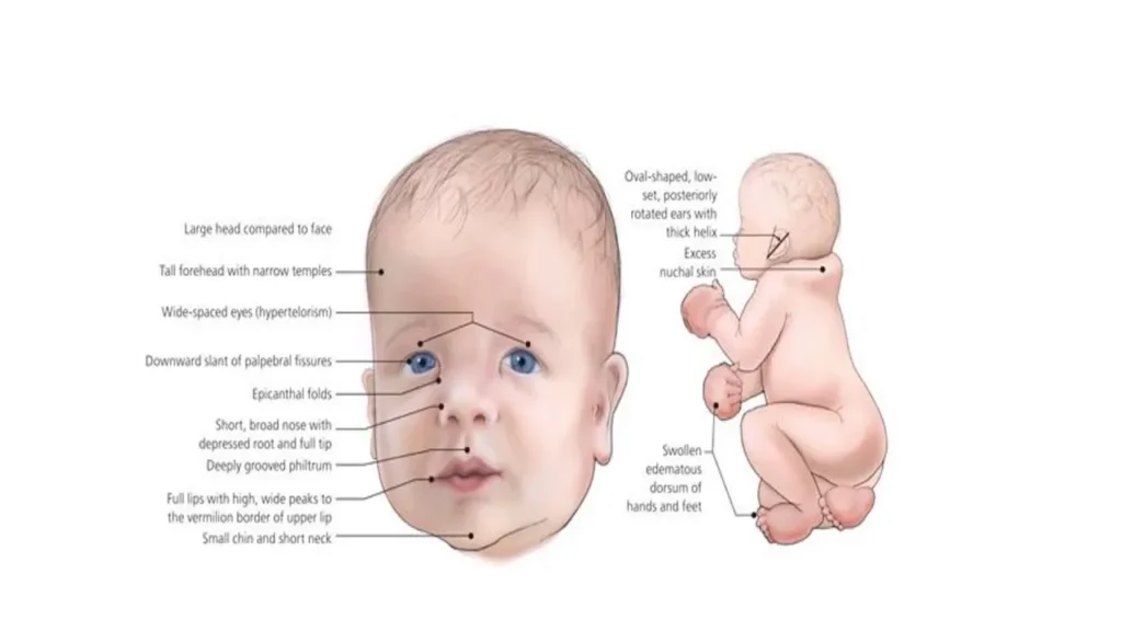 दीजॉर्ज सिंड्रोम (DiGeorge Syndrome)
