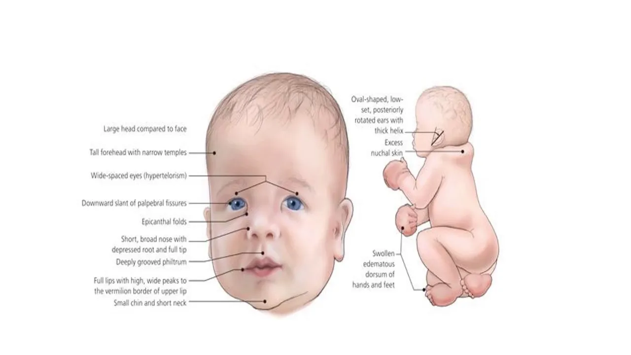 दीजॉर्ज सिंड्रोम (DiGeorge Syndrome)