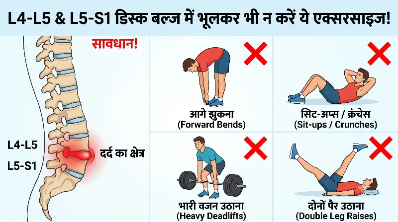 L4-L5 और L5-S1 डिस्क बल्ज में कौन सी एक्सरसाइज बिल्कुल न करें