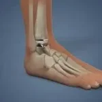 एंकल वेट (Ankle Weights): घुटने की सर्जरी के बाद इसका सही इस्तेमाल कैसे करें?