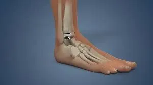 एंकल वेट (Ankle Weights): घुटने की सर्जरी के बाद इसका सही इस्तेमाल कैसे करें?