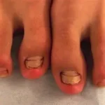 पैरों में छाले (Blisters) और काले नाखून (Black Toenails) से बचने के लिए धावकों के टिप्स दौड़ना एक बेहतरीन एक्सरसाइज है, जो हृदय को स्वस्थ रखने, वजन नियंत्रित करने, मांसपेशियों को मजबूत बनाने और मानसिक स्वास्थ्य बेहतर करने में मदद करती है। लेकिन नियमित रूप से दौड़ने वाले कई लोगों को पैरों में छाले (Blisters), नाखूनों में दर्द और काले नाखून (Black Toenails) जैसी समस्याओं का सामना करना पड़ता है। ये समस्याएँ खासतौर पर लंबी दूरी की दौड़, मैराथन, ट्रेल रनिंग और गर्म मौसम में अधिक देखने को मिलती हैं। शुरुआत में ये परेशानियाँ छोटी लग सकती हैं, लेकिन समय पर ध्यान न देने पर दौड़ने में दर्द, संक्रमण और ट्रेनिंग में लंबे ब्रेक की जरूरत पड़ सकती है। अच्छी बात यह है कि सही रनिंग शूज, मोजे, फुट केयर और ट्रेनिंग की आदतों से इन समस्याओं का जोखिम काफी कम किया जा सकता है। इस लेख में जानेंगे कि पैरों में छाले और नाखून काले क्यों होते हैं, इनसे बचने के लिए धावकों को क्या करना चाहिए और समस्या होने पर सुरक्षित तरीके से रिकवरी कैसे करें। 1. पैरों में छाले (Blisters) क्या होते हैं? 8 छाले त्वचा की ऊपरी और अंदरूनी परतों के बीच तरल पदार्थ जमा होने से बनने वाले छोटे फफोले होते हैं। दौड़ते समय पैर और जूते के बीच बार-बार घर्षण (Friction) होने के कारण त्वचा को नुकसान पहुँचता है और छाले बन सकते हैं। छाले आमतौर पर इन जगहों पर दिखाई देते हैं: - एड़ी के पीछे या किनारों पर। - पैर की उंगलियों के नीचे। - अंगूठे और छोटी उंगली के आसपास। - पैर के तलवे और आर्च वाले हिस्से में। छाले होने के मुख्य कारण 1. गलत फिटिंग वाले जूते: बहुत टाइट जूते उंगलियों और त्वचा पर दबाव डालते हैं, जबकि ढीले जूते पैर को अंदर खिसकने देते हैं। दोनों स्थितियों में घर्षण बढ़ सकता है। 2. पसीना और नमी: गीली त्वचा घर्षण से होने वाली चोट के प्रति अधिक संवेदनशील हो सकती है। 3. नए जूतों में लंबी दौड़: बिना धीरे-धीरे आदत डाले नए जूतों में लंबी दूरी तय करने से छालों का जोखिम बढ़ सकता है। 4. अचानक ट्रेनिंग बढ़ाना: दूरी, गति या दौड़ने का समय तेजी से बढ़ाने से पैरों पर अतिरिक्त दबाव पड़ता है। 5. गलत मोजे: सूती मोजे पसीना सोखकर देर तक गीले रह सकते हैं। इससे त्वचा में घर्षण बढ़ सकता है। 2. काले नाखून (Black Toenails) क्यों होते हैं? 10 दौड़ने के बाद पैर के नाखून का काला, बैंगनी या गहरा लाल दिखाई देना अक्सर नाखून के नीचे खून जमा होने के कारण होता है। इसे मेडिकल भाषा में सबंगुअल हेमेटोमा (Subungual Hematoma) कहा जाता है। दौड़ते समय पैर बार-बार जूते के आगे वाले हिस्से से टकराता है, जिससे नाखून के नीचे की छोटी रक्त वाहिकाओं को चोट लग सकती है। इसके कारण नाखून के नीचे रक्त जमा हो जाता है और उसका रंग बदल जाता है। काले नाखून होने के प्रमुख कारण - बहुत छोटे या टाइट रनिंग शूज पहनना। - जूते के अगले हिस्से में उंगलियों के लिए पर्याप्त जगह न होना। - डाउनहिल रनिंग में पैर का आगे की ओर खिसकना। - लंबी दूरी की दौड़ में बार-बार दबाव पड़ना। - नाखून बहुत लंबे रखना। - अचानक ट्रेनिंग की दूरी या अवधि बढ़ाना। - पैर पर सीधी चोट लगना। कभी-कभी फंगल संक्रमण या अन्य नाखून संबंधी समस्याएँ भी नाखून का रंग बदल सकती हैं। इसलिए हर काले नाखून को केवल दौड़ने का परिणाम नहीं मानना चाहिए। 3. सही रनिंग शूज चुनें छालों और काले नाखूनों से बचने के लिए सही जूते चुनना सबसे महत्वपूर्ण कदमों में से एक है। जूते खरीदते समय इन बातों का ध्यान रखें उंगलियों के लिए पर्याप्त जगह: जूते के आगे वाले हिस्से में उंगलियाँ आराम से हिलनी चाहिए। सामान्य तौर पर सबसे लंबी उंगली के आगे लगभग आधे से एक अंगूठे की चौड़ाई जितनी जगह उपयोगी रहती है, हालांकि फिटिंग पैर के आकार पर निर्भर करती है। सही चौड़ाई: जूते की चौड़ाई ऐसी होनी चाहिए कि उंगलियाँ दबें नहीं। केवल लंबाई सही होना पर्याप्त नहीं है। एड़ी की स्थिरता: जूते की एड़ी पैर को स्थिर रखे। बार-बार एड़ी का ऊपर-नीचे खिसकना छालों का कारण बन सकता है। दौड़ने के लिए उपयुक्त डिजाइन: अपने रनिंग स्टाइल, पैर के आकार और आराम के अनुसार जूते चुनें। केवल किसी खास ब्रांड या महंगे मॉडल को बेहतर मानकर न खरीदें। दौड़ने के समय फिटिंग जाँचें: दिन के अंत में या दौड़ने के बाद पैर कुछ फैल सकते हैं। इसलिए जूते पहनकर चलें और देखें कि उंगलियों पर दबाव तो नहीं पड़ रहा। यदि आप डाउनहिल रनिंग या मैराथन करते हैं, तो जूतों की फिटिंग विशेष रूप से जाँचें क्योंकि लंबी दूरी में पैर आगे की ओर खिसक सकता है। 4. सही मोजे पहनना क्यों जरूरी है? norfolksocks.com रनिंग मोजे त्वचा और जूतों के बीच घर्षण को नियंत्रित करने में मदद करते हैं। सही मोजे छालों की संभावना कम कर सकते हैं। - नमी सोखने वाले मोजे चुनें: पॉलिएस्टर, नायलॉन या उपयुक्त मेरिनो वूल ब्लेंड जैसे तकनीकी फैब्रिक उपयोगी हो सकते हैं। - सही साइज पहनें: मोजे में सिलवटें नहीं पड़नी चाहिए और वे पैर पर बहुत टाइट भी नहीं होने चाहिए। - सीमलेस डिजाइन पर विचार करें: उंगलियों के पास मोटी सिलाई वाले मोजे कुछ धावकों में घर्षण बढ़ा सकते हैं। - लंबी दौड़ में अतिरिक्त जोड़ी रखें: जरूरत पड़ने पर गीले मोजे बदलें। - गीले मोजों में दौड़ने से बचें: बारिश या अत्यधिक पसीने के कारण मोजे गीले हो जाएँ तो उन्हें बदलना बेहतर है। हर धावक के लिए एक ही तरह के मोजे उपयुक्त नहीं होते। यदि बार-बार एक ही जगह छाले पड़ते हैं, तो अलग मोटाई या डिजाइन वाले मोजों को छोटी दूरी पर आजमाएँ। 5. नाखूनों की सही देखभाल करें पैरों के नाखून बहुत लंबे होने पर दौड़ते समय जूते के अगले हिस्से से टकरा सकते हैं। इससे नाखून के नीचे चोट लगने की संभावना बढ़ जाती है। नाखूनों की देखभाल के लिए: 1. नाखूनों को नियमित रूप से काटें। 2. उन्हें बहुत छोटा काटने से बचें। 3. नाखूनों को लगभग सीधा काटें और नुकीले किनारों को हल्के से फाइल करें। 4. नाखून के किनारों को बहुत गहराई तक न काटें। 5. दौड़ से पहले देखें कि कोई नाखून जूते के अंदर दब तो नहीं रहा। 6. नाखून में दर्द, सूजन या रंग बदलने पर स्थिति पर ध्यान दें। मैराथन या लंबी दूरी की दौड़ से ठीक पहले नाखून काटने के बजाय कुछ दिन पहले काटना सुविधाजनक हो सकता है, ताकि त्वचा में हुई छोटी चोट को ठीक होने का समय मिल सके। 6. दौड़ने से पहले पैरों की तैयारी करें पैरों की त्वचा की स्थिति पर ध्यान देने से छालों का जोखिम कम किया जा सकता है। एंटी-फ्रिक्शन बाम: जिन जगहों पर बार-बार छाले पड़ते हैं, वहाँ उपयुक्त एंटी-फ्रिक्शन बाम या पेट्रोलियम जेली की पतली परत मदद कर सकती है। इसे त्वचा पर इस्तेमाल करें, लेकिन जूते के अंदर जरूरत से ज्यादा चिकनाई न लगाएँ क्योंकि इससे पैर फिसल सकता है। ब्लिस्टर टेप: एड़ी या उंगलियों पर बार-बार छाले पड़ते हों तो सही तरीके से लगाया गया स्पोर्ट्स टेप या ब्लिस्टर पैड घर्षण कम करने में मदद कर सकता है। टेप लगाने से पहले त्वचा साफ और सूखी रखें। पैरों की जाँच: दौड़ने से पहले किसी कट, लालिमा, छाले या नाखून में दर्द की जाँच करें। त्वचा की देखभाल: पैरों को साफ रखें और धोने के बाद अच्छी तरह सुखाएँ, विशेषकर उंगलियों के बीच। बहुत सूखी त्वचा में उपयुक्त मॉइस्चराइजर मदद कर सकता है, लेकिन उंगलियों के बीच अधिक नमी न रहने दें। 7. ट्रेनिंग का भार धीरे-धीरे बढ़ाएँ यदि आप शुरुआत कर रहे हैं या लंबे ब्रेक के बाद दौड़ना शुरू कर रहे हैं, तो पहले दिन से लंबी दूरी तय करने की कोशिश न करें। - अपनी वर्तमान क्षमता के अनुसार छोटी दूरी से शुरुआत करें। - दूरी और गति धीरे-धीरे बढ़ाएँ। - नए जूतों को पहले छोटी और आसान दौड़ में आजमाएँ। - लंबी दौड़ से पहले मोजे, जूते और एंटी-फ्रिक्शन उत्पादों का परीक्षण करें। - दौड़ते समय दर्द या असामान्य दबाव महसूस हो तो उसे नजरअंदाज न करें। दूरी बढ़ाने का कोई एक नियम सभी धावकों पर लागू नहीं होता। अपनी रिकवरी, ट्रेनिंग अनुभव और पैरों की प्रतिक्रिया के अनुसार योजना बनाएँ। यदि मैराथन की तैयारी कर रहे हैं, तो प्रतियोगिता के दिन पहली बार नए जूते, मोजे या कोई नया फुट केयर उत्पाद इस्तेमाल न करें। 8. दौड़ते समय छाला बन जाए तो क्या करें? छाला बनते समय जलन, चुभन या त्वचा में दर्द महसूस हो सकता है। ऐसी स्थिति में दर्द के बावजूद दौड़ जारी रखना समस्या को बढ़ा सकता है। छोटे और बंद छाले के लिए: - प्रभावित जगह को साफ और सूखा रखें। - छाले को फोड़ने से बचें। - उसे मुलायम पैड या उपयुक्त ब्लिस्टर ड्रेसिंग से सुरक्षित रखें। - जूते और मोजों की फिटिंग जाँचें। - दर्द बना रहे तो दौड़ रोक दें और त्वचा को ठीक होने का समय दें। यदि छाला फट जाए: - हाथ धोकर प्रभावित हिस्से को साफ पानी से धीरे-धीरे साफ करें। - ऊपर की त्वचा को जबरदस्ती न खींचें। - साफ, न चिपकने वाली ड्रेसिंग लगाएँ। - ड्रेसिंग बदलते रहें और संक्रमण के संकेतों पर ध्यान दें। छाले को खुद सुई से फोड़ना संक्रमण का जोखिम बढ़ा सकता है। यदि छाला बहुत बड़ा या बेहद दर्दनाक है, तो स्वास्थ्य विशेषज्ञ से सलाह लें। जरूरत पड़ने पर वे इसे सुरक्षित तरीके से निकाल सकते हैं। 9. काला नाखून होने पर क्या करें? यदि नाखून के नीचे खून जमा हो गया है, तो हल्का रंग परिवर्तन कभी-कभी बिना किसी विशेष उपचार के धीरे-धीरे ठीक हो सकता है। लेकिन नाखून का रंग सामान्य होने में कई महीने लग सकते हैं, क्योंकि पैर के नाखून धीरे बढ़ते हैं। - टाइट जूते पहनना बंद करें और पैर की उंगलियों को पर्याप्त जगह दें। - दर्द वाले नाखून पर दबाव न डालें। - नाखून को खुद छेदकर खून निकालने की कोशिश न करें। - यदि चोट के बाद तेज धड़कता हुआ दर्द हो, तो जल्द चिकित्सा सहायता लें। स्वास्थ्य विशेषज्ञ जरूरत पड़ने पर नाखून के नीचे जमा खून को निकाल सकते हैं। - नाखून उठने लगे, बहुत दर्द हो या गंभीर चोट लगी हो, तो जाँच करवाएँ। यदि बिना स्पष्ट चोट के नाखून काला हो जाए, रंग बदलने का कारण स्पष्ट न हो, या नाखून पर गहरी पट्टी बने और बढ़ती जाए, तो त्वचा विशेषज्ञ से जाँच करवाएँ। बहुत कम मामलों में नाखून का लगातार बना रहने वाला काला निशान किसी गंभीर त्वचा रोग का संकेत भी हो सकता है। मधुमेह, पैरों में कम संवेदना या खराब रक्त संचार वाले लोगों को छालों और नाखून की चोट के मामले में जल्दी चिकित्सकीय सलाह लेनी चाहिए। 10. किन लक्षणों में डॉक्टर से संपर्क करें? निम्नलिखित लक्षणों को नजरअंदाज न करें: - नाखून के नीचे तेज या बढ़ता हुआ दर्द। - पैर में बढ़ती लालिमा, गर्माहट या सूजन। - छाले से पस निकलना या बुखार होना। - नाखून का अपनी जगह से उठना। - पैर पर वजन रखने में परेशानी। - बिना कारण नाखून का काला होना। - बार-बार छाले बनना, जबकि जूते और मोजे सही हों। इन लक्षणों में डॉक्टर या योग्य स्वास्थ्य विशेषज्ञ से जाँच करवाना जरूरी है। संक्रमण या गंभीर चोट होने पर केवल घरेलू उपचार पर्याप्त नहीं हो सकता। निष्कर्ष पैरों में छाले और काले नाखून धावकों की आम समस्याएँ हैं, लेकिन सही सावधानियों से इनके जोखिम को कम किया जा सकता है। सही फिटिंग वाले रनिंग शूज, नमी सोखने वाले मोजे, नाखूनों की नियमित देखभाल, एंटी-फ्रिक्शन उत्पादों का उचित उपयोग और ट्रेनिंग का भार धीरे-धीरे बढ़ाना सबसे उपयोगी कदम हैं। यदि दौड़ते समय लगातार घर्षण, दबाव या दर्द महसूस हो, तो उसे अनदेखा न करें। समय पर जूते और मोजों की फिटिंग सुधारें और जरूरत पड़ने पर विशेषज्ञ की मदद लें। याद रखें, अच्छी रनिंग केवल तेज दौड़ने या लंबी दूरी तय करने के बारे में नहीं है। अपने पैरों की देखभाल करना भी सुरक्षित और लंबे समय तक दौड़ते रहने का एक महत्वपूर्ण हिस्सा है। अस्वीकरण: यह लेख सामान्य स्वास्थ्य एवं फिटनेस जानकारी के लिए है। लगातार दर्द, संक्रमण के संकेत या गंभीर नाखून की चोट होने पर योग्य स्वास्थ्य विशेषज्ञ से परामर्श लें।