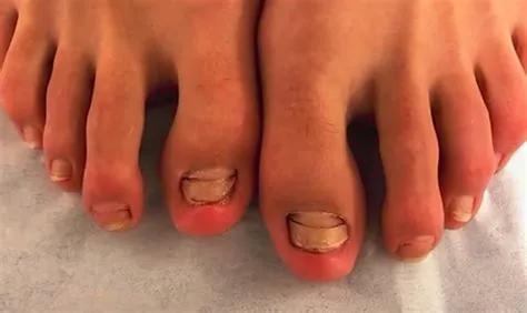पैरों में छाले (Blisters) और काले नाखून (Black Toenails) से बचने के लिए धावकों के टिप्स दौड़ना एक बेहतरीन एक्सरसाइज है, जो हृदय को स्वस्थ रखने, वजन नियंत्रित करने, मांसपेशियों को मजबूत बनाने और मानसिक स्वास्थ्य बेहतर करने में मदद करती है। लेकिन नियमित रूप से दौड़ने वाले कई लोगों को पैरों में छाले (Blisters), नाखूनों में दर्द और काले नाखून (Black Toenails) जैसी समस्याओं का सामना करना पड़ता है। ये समस्याएँ खासतौर पर लंबी दूरी की दौड़, मैराथन, ट्रेल रनिंग और गर्म मौसम में अधिक देखने को मिलती हैं। शुरुआत में ये परेशानियाँ छोटी लग सकती हैं, लेकिन समय पर ध्यान न देने पर दौड़ने में दर्द, संक्रमण और ट्रेनिंग में लंबे ब्रेक की जरूरत पड़ सकती है। अच्छी बात यह है कि सही रनिंग शूज, मोजे, फुट केयर और ट्रेनिंग की आदतों से इन समस्याओं का जोखिम काफी कम किया जा सकता है। इस लेख में जानेंगे कि पैरों में छाले और नाखून काले क्यों होते हैं, इनसे बचने के लिए धावकों को क्या करना चाहिए और समस्या होने पर सुरक्षित तरीके से रिकवरी कैसे करें। 1. पैरों में छाले (Blisters) क्या होते हैं? 8 छाले त्वचा की ऊपरी और अंदरूनी परतों के बीच तरल पदार्थ जमा होने से बनने वाले छोटे फफोले होते हैं। दौड़ते समय पैर और जूते के बीच बार-बार घर्षण (Friction) होने के कारण त्वचा को नुकसान पहुँचता है और छाले बन सकते हैं। छाले आमतौर पर इन जगहों पर दिखाई देते हैं: - एड़ी के पीछे या किनारों पर। - पैर की उंगलियों के नीचे। - अंगूठे और छोटी उंगली के आसपास। - पैर के तलवे और आर्च वाले हिस्से में। छाले होने के मुख्य कारण 1. गलत फिटिंग वाले जूते: बहुत टाइट जूते उंगलियों और त्वचा पर दबाव डालते हैं, जबकि ढीले जूते पैर को अंदर खिसकने देते हैं। दोनों स्थितियों में घर्षण बढ़ सकता है। 2. पसीना और नमी: गीली त्वचा घर्षण से होने वाली चोट के प्रति अधिक संवेदनशील हो सकती है। 3. नए जूतों में लंबी दौड़: बिना धीरे-धीरे आदत डाले नए जूतों में लंबी दूरी तय करने से छालों का जोखिम बढ़ सकता है। 4. अचानक ट्रेनिंग बढ़ाना: दूरी, गति या दौड़ने का समय तेजी से बढ़ाने से पैरों पर अतिरिक्त दबाव पड़ता है। 5. गलत मोजे: सूती मोजे पसीना सोखकर देर तक गीले रह सकते हैं। इससे त्वचा में घर्षण बढ़ सकता है। 2. काले नाखून (Black Toenails) क्यों होते हैं? 10 दौड़ने के बाद पैर के नाखून का काला, बैंगनी या गहरा लाल दिखाई देना अक्सर नाखून के नीचे खून जमा होने के कारण होता है। इसे मेडिकल भाषा में सबंगुअल हेमेटोमा (Subungual Hematoma) कहा जाता है। दौड़ते समय पैर बार-बार जूते के आगे वाले हिस्से से टकराता है, जिससे नाखून के नीचे की छोटी रक्त वाहिकाओं को चोट लग सकती है। इसके कारण नाखून के नीचे रक्त जमा हो जाता है और उसका रंग बदल जाता है। काले नाखून होने के प्रमुख कारण - बहुत छोटे या टाइट रनिंग शूज पहनना। - जूते के अगले हिस्से में उंगलियों के लिए पर्याप्त जगह न होना। - डाउनहिल रनिंग में पैर का आगे की ओर खिसकना। - लंबी दूरी की दौड़ में बार-बार दबाव पड़ना। - नाखून बहुत लंबे रखना। - अचानक ट्रेनिंग की दूरी या अवधि बढ़ाना। - पैर पर सीधी चोट लगना। कभी-कभी फंगल संक्रमण या अन्य नाखून संबंधी समस्याएँ भी नाखून का रंग बदल सकती हैं। इसलिए हर काले नाखून को केवल दौड़ने का परिणाम नहीं मानना चाहिए। 3. सही रनिंग शूज चुनें छालों और काले नाखूनों से बचने के लिए सही जूते चुनना सबसे महत्वपूर्ण कदमों में से एक है। जूते खरीदते समय इन बातों का ध्यान रखें उंगलियों के लिए पर्याप्त जगह: जूते के आगे वाले हिस्से में उंगलियाँ आराम से हिलनी चाहिए। सामान्य तौर पर सबसे लंबी उंगली के आगे लगभग आधे से एक अंगूठे की चौड़ाई जितनी जगह उपयोगी रहती है, हालांकि फिटिंग पैर के आकार पर निर्भर करती है। सही चौड़ाई: जूते की चौड़ाई ऐसी होनी चाहिए कि उंगलियाँ दबें नहीं। केवल लंबाई सही होना पर्याप्त नहीं है। एड़ी की स्थिरता: जूते की एड़ी पैर को स्थिर रखे। बार-बार एड़ी का ऊपर-नीचे खिसकना छालों का कारण बन सकता है। दौड़ने के लिए उपयुक्त डिजाइन: अपने रनिंग स्टाइल, पैर के आकार और आराम के अनुसार जूते चुनें। केवल किसी खास ब्रांड या महंगे मॉडल को बेहतर मानकर न खरीदें। दौड़ने के समय फिटिंग जाँचें: दिन के अंत में या दौड़ने के बाद पैर कुछ फैल सकते हैं। इसलिए जूते पहनकर चलें और देखें कि उंगलियों पर दबाव तो नहीं पड़ रहा। यदि आप डाउनहिल रनिंग या मैराथन करते हैं, तो जूतों की फिटिंग विशेष रूप से जाँचें क्योंकि लंबी दूरी में पैर आगे की ओर खिसक सकता है। 4. सही मोजे पहनना क्यों जरूरी है? norfolksocks.com रनिंग मोजे त्वचा और जूतों के बीच घर्षण को नियंत्रित करने में मदद करते हैं। सही मोजे छालों की संभावना कम कर सकते हैं। - नमी सोखने वाले मोजे चुनें: पॉलिएस्टर, नायलॉन या उपयुक्त मेरिनो वूल ब्लेंड जैसे तकनीकी फैब्रिक उपयोगी हो सकते हैं। - सही साइज पहनें: मोजे में सिलवटें नहीं पड़नी चाहिए और वे पैर पर बहुत टाइट भी नहीं होने चाहिए। - सीमलेस डिजाइन पर विचार करें: उंगलियों के पास मोटी सिलाई वाले मोजे कुछ धावकों में घर्षण बढ़ा सकते हैं। - लंबी दौड़ में अतिरिक्त जोड़ी रखें: जरूरत पड़ने पर गीले मोजे बदलें। - गीले मोजों में दौड़ने से बचें: बारिश या अत्यधिक पसीने के कारण मोजे गीले हो जाएँ तो उन्हें बदलना बेहतर है। हर धावक के लिए एक ही तरह के मोजे उपयुक्त नहीं होते। यदि बार-बार एक ही जगह छाले पड़ते हैं, तो अलग मोटाई या डिजाइन वाले मोजों को छोटी दूरी पर आजमाएँ। 5. नाखूनों की सही देखभाल करें पैरों के नाखून बहुत लंबे होने पर दौड़ते समय जूते के अगले हिस्से से टकरा सकते हैं। इससे नाखून के नीचे चोट लगने की संभावना बढ़ जाती है। नाखूनों की देखभाल के लिए: 1. नाखूनों को नियमित रूप से काटें। 2. उन्हें बहुत छोटा काटने से बचें। 3. नाखूनों को लगभग सीधा काटें और नुकीले किनारों को हल्के से फाइल करें। 4. नाखून के किनारों को बहुत गहराई तक न काटें। 5. दौड़ से पहले देखें कि कोई नाखून जूते के अंदर दब तो नहीं रहा। 6. नाखून में दर्द, सूजन या रंग बदलने पर स्थिति पर ध्यान दें। मैराथन या लंबी दूरी की दौड़ से ठीक पहले नाखून काटने के बजाय कुछ दिन पहले काटना सुविधाजनक हो सकता है, ताकि त्वचा में हुई छोटी चोट को ठीक होने का समय मिल सके। 6. दौड़ने से पहले पैरों की तैयारी करें पैरों की त्वचा की स्थिति पर ध्यान देने से छालों का जोखिम कम किया जा सकता है। एंटी-फ्रिक्शन बाम: जिन जगहों पर बार-बार छाले पड़ते हैं, वहाँ उपयुक्त एंटी-फ्रिक्शन बाम या पेट्रोलियम जेली की पतली परत मदद कर सकती है। इसे त्वचा पर इस्तेमाल करें, लेकिन जूते के अंदर जरूरत से ज्यादा चिकनाई न लगाएँ क्योंकि इससे पैर फिसल सकता है। ब्लिस्टर टेप: एड़ी या उंगलियों पर बार-बार छाले पड़ते हों तो सही तरीके से लगाया गया स्पोर्ट्स टेप या ब्लिस्टर पैड घर्षण कम करने में मदद कर सकता है। टेप लगाने से पहले त्वचा साफ और सूखी रखें। पैरों की जाँच: दौड़ने से पहले किसी कट, लालिमा, छाले या नाखून में दर्द की जाँच करें। त्वचा की देखभाल: पैरों को साफ रखें और धोने के बाद अच्छी तरह सुखाएँ, विशेषकर उंगलियों के बीच। बहुत सूखी त्वचा में उपयुक्त मॉइस्चराइजर मदद कर सकता है, लेकिन उंगलियों के बीच अधिक नमी न रहने दें। 7. ट्रेनिंग का भार धीरे-धीरे बढ़ाएँ यदि आप शुरुआत कर रहे हैं या लंबे ब्रेक के बाद दौड़ना शुरू कर रहे हैं, तो पहले दिन से लंबी दूरी तय करने की कोशिश न करें। - अपनी वर्तमान क्षमता के अनुसार छोटी दूरी से शुरुआत करें। - दूरी और गति धीरे-धीरे बढ़ाएँ। - नए जूतों को पहले छोटी और आसान दौड़ में आजमाएँ। - लंबी दौड़ से पहले मोजे, जूते और एंटी-फ्रिक्शन उत्पादों का परीक्षण करें। - दौड़ते समय दर्द या असामान्य दबाव महसूस हो तो उसे नजरअंदाज न करें। दूरी बढ़ाने का कोई एक नियम सभी धावकों पर लागू नहीं होता। अपनी रिकवरी, ट्रेनिंग अनुभव और पैरों की प्रतिक्रिया के अनुसार योजना बनाएँ। यदि मैराथन की तैयारी कर रहे हैं, तो प्रतियोगिता के दिन पहली बार नए जूते, मोजे या कोई नया फुट केयर उत्पाद इस्तेमाल न करें। 8. दौड़ते समय छाला बन जाए तो क्या करें? छाला बनते समय जलन, चुभन या त्वचा में दर्द महसूस हो सकता है। ऐसी स्थिति में दर्द के बावजूद दौड़ जारी रखना समस्या को बढ़ा सकता है। छोटे और बंद छाले के लिए: - प्रभावित जगह को साफ और सूखा रखें। - छाले को फोड़ने से बचें। - उसे मुलायम पैड या उपयुक्त ब्लिस्टर ड्रेसिंग से सुरक्षित रखें। - जूते और मोजों की फिटिंग जाँचें। - दर्द बना रहे तो दौड़ रोक दें और त्वचा को ठीक होने का समय दें। यदि छाला फट जाए: - हाथ धोकर प्रभावित हिस्से को साफ पानी से धीरे-धीरे साफ करें। - ऊपर की त्वचा को जबरदस्ती न खींचें। - साफ, न चिपकने वाली ड्रेसिंग लगाएँ। - ड्रेसिंग बदलते रहें और संक्रमण के संकेतों पर ध्यान दें। छाले को खुद सुई से फोड़ना संक्रमण का जोखिम बढ़ा सकता है। यदि छाला बहुत बड़ा या बेहद दर्दनाक है, तो स्वास्थ्य विशेषज्ञ से सलाह लें। जरूरत पड़ने पर वे इसे सुरक्षित तरीके से निकाल सकते हैं। 9. काला नाखून होने पर क्या करें? यदि नाखून के नीचे खून जमा हो गया है, तो हल्का रंग परिवर्तन कभी-कभी बिना किसी विशेष उपचार के धीरे-धीरे ठीक हो सकता है। लेकिन नाखून का रंग सामान्य होने में कई महीने लग सकते हैं, क्योंकि पैर के नाखून धीरे बढ़ते हैं। - टाइट जूते पहनना बंद करें और पैर की उंगलियों को पर्याप्त जगह दें। - दर्द वाले नाखून पर दबाव न डालें। - नाखून को खुद छेदकर खून निकालने की कोशिश न करें। - यदि चोट के बाद तेज धड़कता हुआ दर्द हो, तो जल्द चिकित्सा सहायता लें। स्वास्थ्य विशेषज्ञ जरूरत पड़ने पर नाखून के नीचे जमा खून को निकाल सकते हैं। - नाखून उठने लगे, बहुत दर्द हो या गंभीर चोट लगी हो, तो जाँच करवाएँ। यदि बिना स्पष्ट चोट के नाखून काला हो जाए, रंग बदलने का कारण स्पष्ट न हो, या नाखून पर गहरी पट्टी बने और बढ़ती जाए, तो त्वचा विशेषज्ञ से जाँच करवाएँ। बहुत कम मामलों में नाखून का लगातार बना रहने वाला काला निशान किसी गंभीर त्वचा रोग का संकेत भी हो सकता है। मधुमेह, पैरों में कम संवेदना या खराब रक्त संचार वाले लोगों को छालों और नाखून की चोट के मामले में जल्दी चिकित्सकीय सलाह लेनी चाहिए। 10. किन लक्षणों में डॉक्टर से संपर्क करें? निम्नलिखित लक्षणों को नजरअंदाज न करें: - नाखून के नीचे तेज या बढ़ता हुआ दर्द। - पैर में बढ़ती लालिमा, गर्माहट या सूजन। - छाले से पस निकलना या बुखार होना। - नाखून का अपनी जगह से उठना। - पैर पर वजन रखने में परेशानी। - बिना कारण नाखून का काला होना। - बार-बार छाले बनना, जबकि जूते और मोजे सही हों। इन लक्षणों में डॉक्टर या योग्य स्वास्थ्य विशेषज्ञ से जाँच करवाना जरूरी है। संक्रमण या गंभीर चोट होने पर केवल घरेलू उपचार पर्याप्त नहीं हो सकता। निष्कर्ष पैरों में छाले और काले नाखून धावकों की आम समस्याएँ हैं, लेकिन सही सावधानियों से इनके जोखिम को कम किया जा सकता है। सही फिटिंग वाले रनिंग शूज, नमी सोखने वाले मोजे, नाखूनों की नियमित देखभाल, एंटी-फ्रिक्शन उत्पादों का उचित उपयोग और ट्रेनिंग का भार धीरे-धीरे बढ़ाना सबसे उपयोगी कदम हैं। यदि दौड़ते समय लगातार घर्षण, दबाव या दर्द महसूस हो, तो उसे अनदेखा न करें। समय पर जूते और मोजों की फिटिंग सुधारें और जरूरत पड़ने पर विशेषज्ञ की मदद लें। याद रखें, अच्छी रनिंग केवल तेज दौड़ने या लंबी दूरी तय करने के बारे में नहीं है। अपने पैरों की देखभाल करना भी सुरक्षित और लंबे समय तक दौड़ते रहने का एक महत्वपूर्ण हिस्सा है। अस्वीकरण: यह लेख सामान्य स्वास्थ्य एवं फिटनेस जानकारी के लिए है। लगातार दर्द, संक्रमण के संकेत या गंभीर नाखून की चोट होने पर योग्य स्वास्थ्य विशेषज्ञ से परामर्श लें।