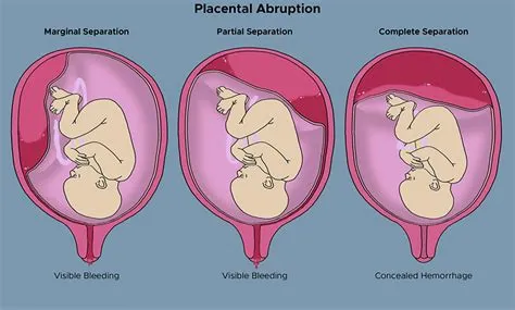 प्लेसेंटल एबर्प्शन (Placental Abruption - गर्भनाल का समय से पहले अलग होना)
