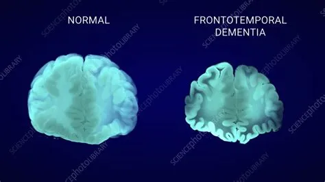 फ्रंटोटेम्पोरल डिमेंशिया (Frontotemporal Dementia)