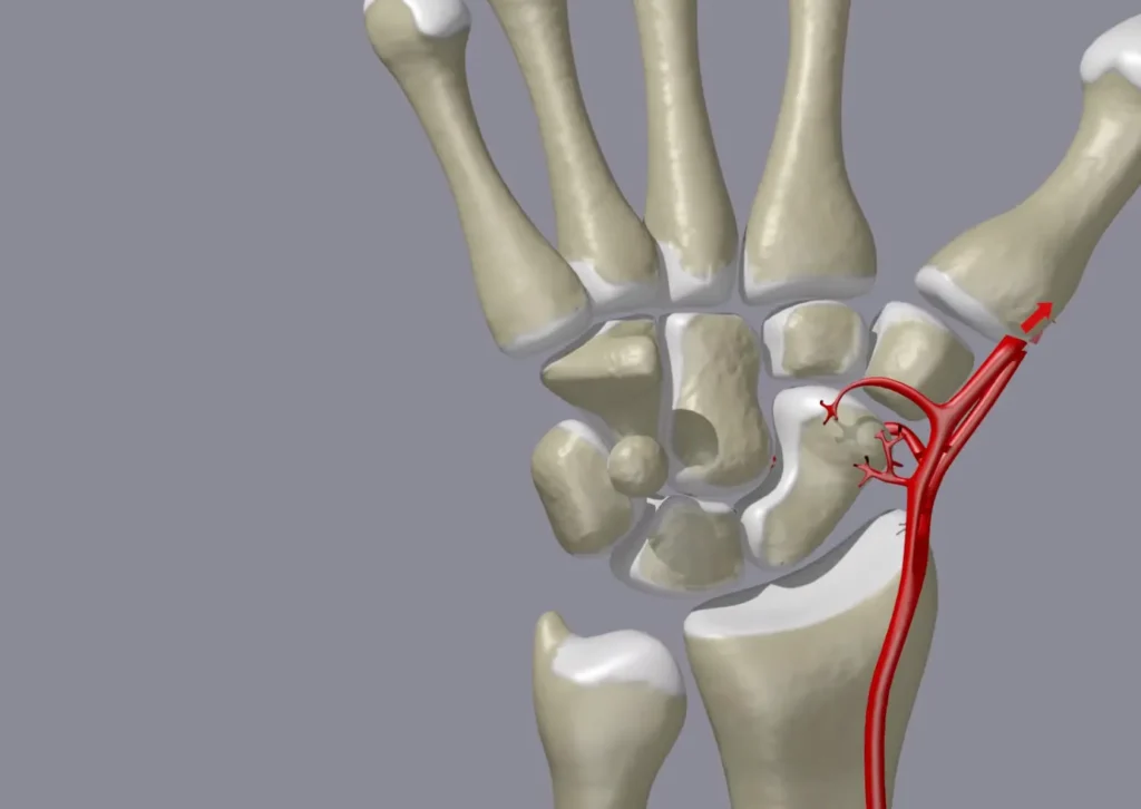 स्कैफॉइड फ्रैक्चर (Scaphoid Fracture - अंगूठे के पास की कलाई की हड्डी टूटना)